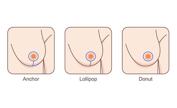 What are the Treatments and Procedures for Breast Lifts - Dr Rajat Gupta - Best Plastic Surgeon in Delhi -02 Breast Lift Options
