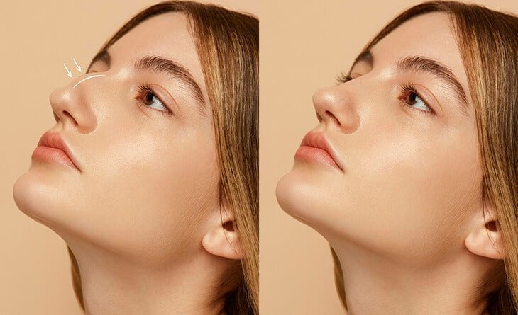 Can Rhinoplasty Correct a Nasal Hump and Crooked Bridge - Dr Rajat Gupta - Plastic Surgeon in Delhi -02 Rhinoplasty Procedure in Delhi