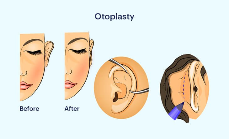 How is Otoplasty Surgery Performed - Dr Rajat Gupta - Plastic Surgeon in Delhi - RG Aesthetics -01 Otoplasty In Delhi