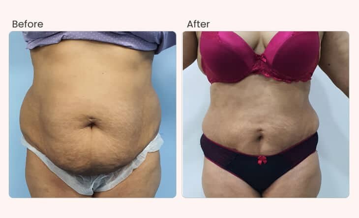 What Body Areas Can be Treated by Liposuction - Dr Rajat Gupta - Plastic Surgeon in Delhi - RG Aesthetics -02 Liposuction procedure in Delhi