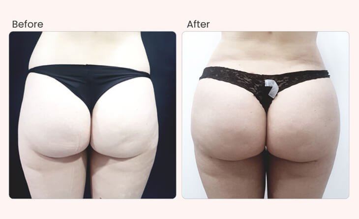 What Body Areas Can be Treated by Liposuction - Dr Rajat Gupta - Plastic Surgeon in Delhi - RG Aesthetics -03 Liposuction procedure in Delhi