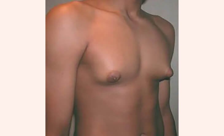 What Is Teenage Gynecomastia - Dr Rajat Gupta - Best Plastic Surgeon in Delhi -RG Aesthetics -02 teenage gynecomastia