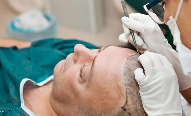 Hair Transplant Is A Permanent Solution or Not - Dr Rajat Gupta - Best Plastic Surgeon in Delhi - RG Aesthetics 02 Hair Transplant in Delhi