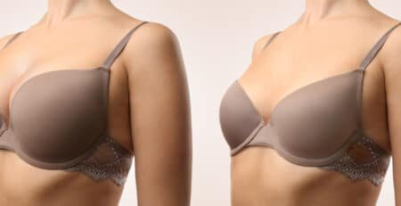breast augmentation surgery in Delhi