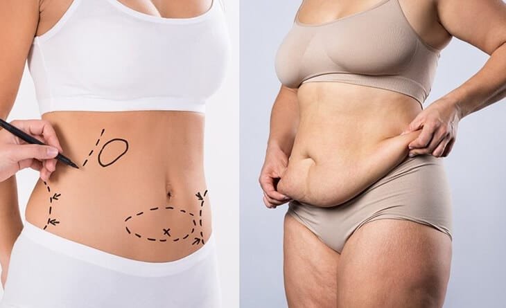 Tummy Tuck or Liposuction – Which One Do I Need - Dr Rajat Gupta - Best Plastic Surgeon in Delhi - RG Aesthetics -01 tummy tuck surgery