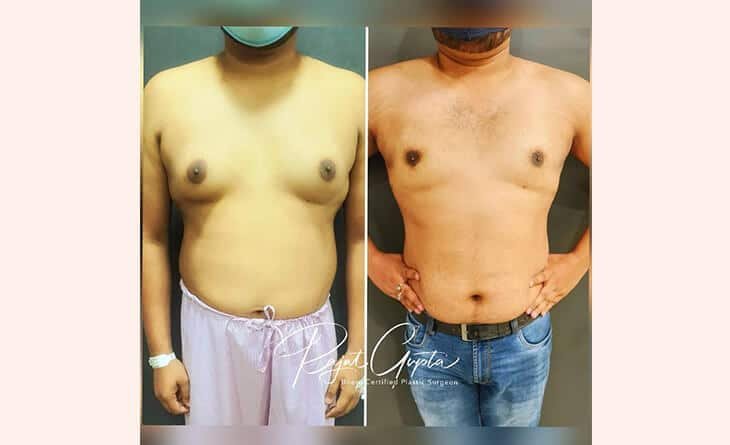 What Men Need to Know Before Having Gynecomastia Surgery - Dr Rajat Gupta - RG Aesthetics -02 gynecomastia surgery procedure