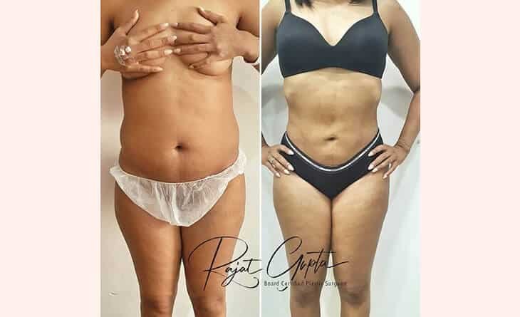 What to Expect After Liposuction – A Look at Recovery and Results - Dr Rajat Gupta - RG Aesthetics -01 Liposuction surgery