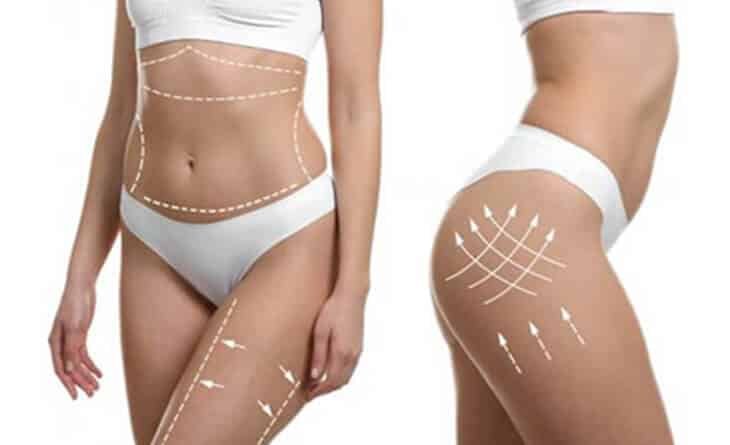 What to Expect After Liposuction – A Look at Recovery and Results - Dr Rajat Gupta - RG Aesthetics -02 Liposuction surgery