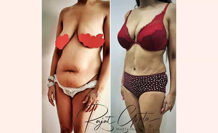 What to Look for When Considering Liposuction Costs - Dr Rajat Gupta - RG Aesthetics -02 Liposuction procedure