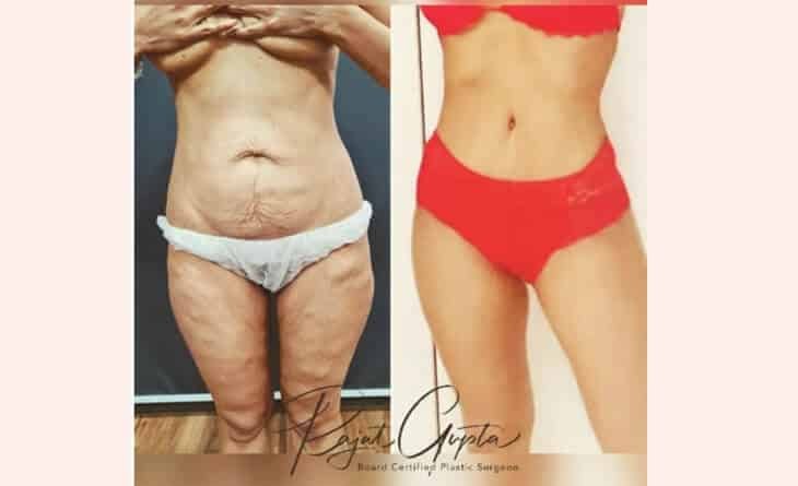 Your 6-Month Guide to Planning A Tummy Tuck - Dr Rajat Gupta - RG Aesthetics -01 Tummy Tuck Before After Result