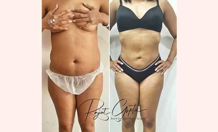 5 Things To Know Before Getting Liposuction - Dr Rajat Gupta - Liposuction-Before-After-Result liposuction surgery