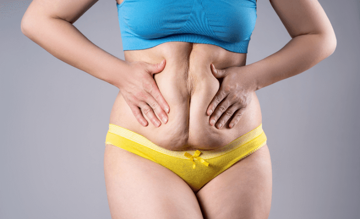 How to Get Rid of Excess Skin After Weight Loss - Dr Rajat Gupta - RG Aesthetics (1) cosmetic surgery Procedure