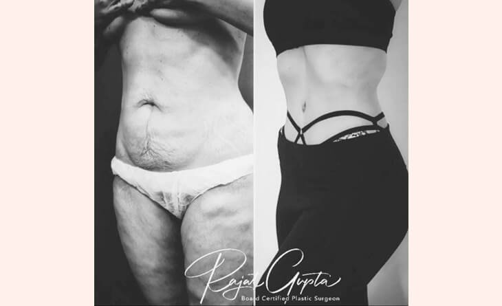 What is A 360 Tummy Tuck - Dr Rajat Gupta - RG Aesthetics -02 tummy tuck surgery