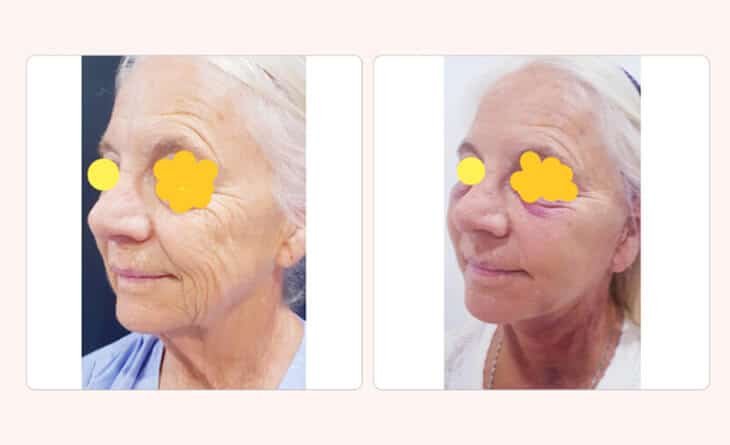 Face Lift – How It Can Make You Look Younger - Dr Rajat Gupta - Plastic Surgeon in Delhi -02 facelift surgery