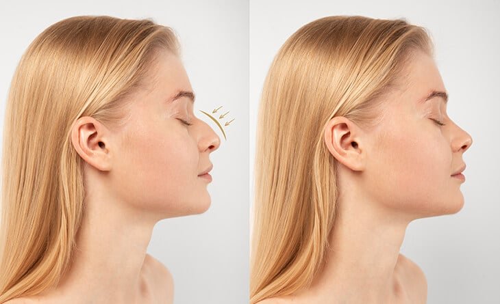 What Is The Success Rate of Rhinoplasty - Dr Rajat Gupta - RG Aesthetics -02 rhinoplasty surgery