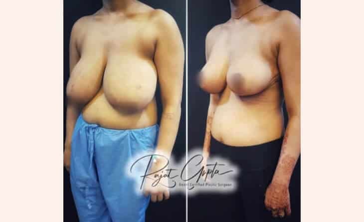 Exploring Your Choices for Cosmetic Breast Reshaping - Dr Rajat Gupta - RG Aesthetics -03 Breast Augmentation Surgery