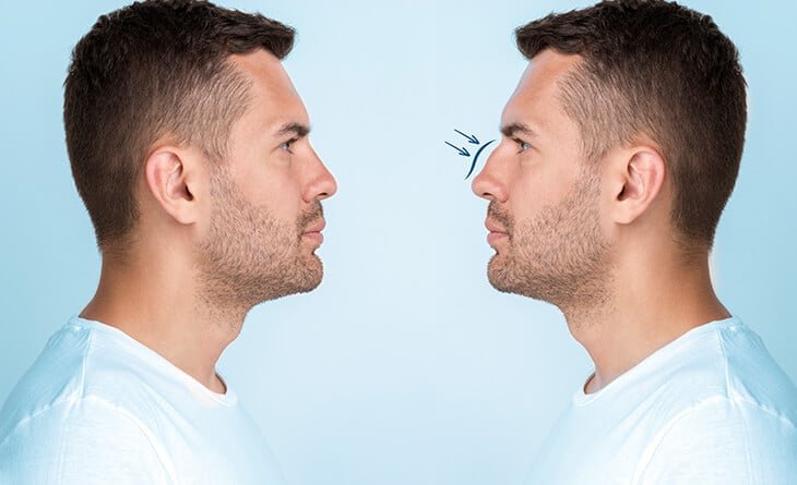 How Long Do You Have To Wait For Revision Rhinoplasty - Dr Rajat Gupta - RG Aesthetics -02 revision rhinoplasty