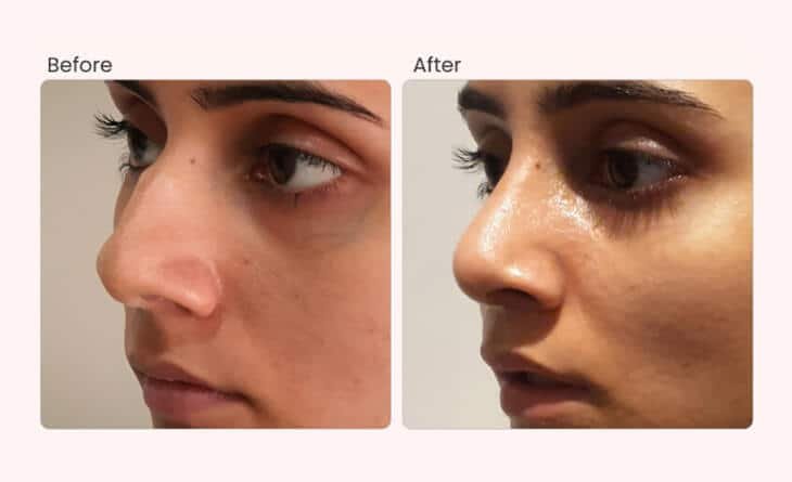 What Not To Do After Rhinoplasty - Dr Rajat Gupta - RG Aesthetics -02 rhinoplasty cost