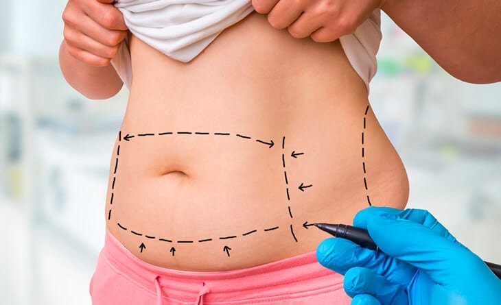 Can A Tummy Tuck Eliminate My Stretch Marks - Dr Rajat Gupta - RG Aesthetics -02 Tummy tuck surgery