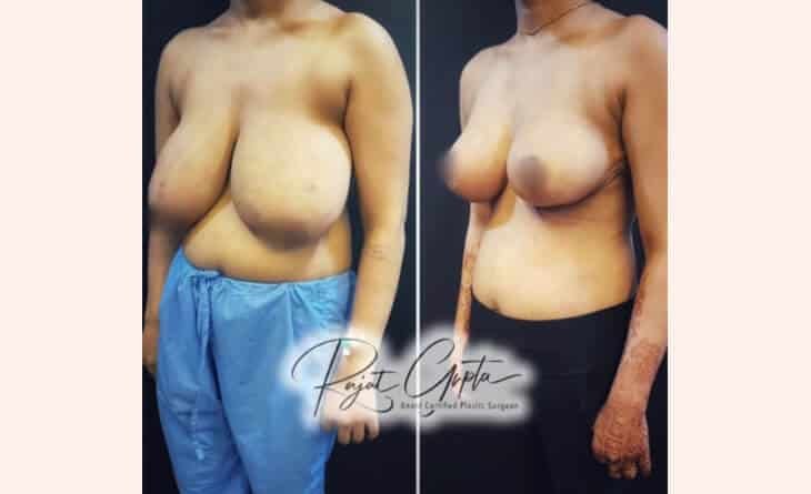 Common Problems after Breast Reduction Surgery - Dr Rajat Gupta - RG Aesthetics -02 breast reduction surgery