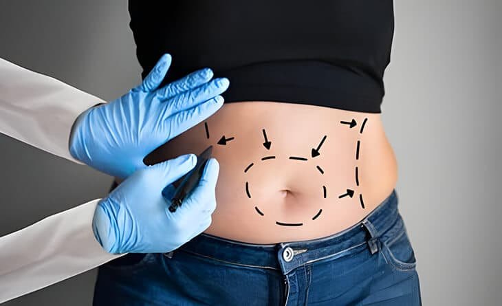 How Long Does it Take to Heal From Liposuction Surgery - Dr Rajat Gupta - Plastic Surgeon in Delhi -02 Liposuction surgery