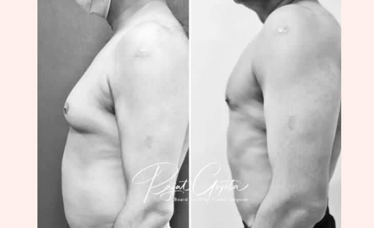 How Long to Wear a Compression Vest after Gynecomastia Surgery - Dr Rajat Gupta - RG Aesthetics -03 Gynecomastia surgery