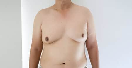Gynecomastia surgery