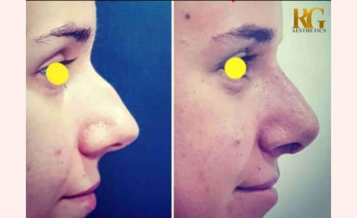 Ultrasonic Nose Job - The Less Invasive Rhinoplasty - Dr Rajat Gupta - RG Aesthetics -01 Ultrasonic nose job