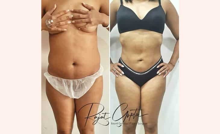 Liposuction Surgery Before and After Results - Dr Rajat Gupta - Plastic Surgeon in Delhi -02 liposuction surgery