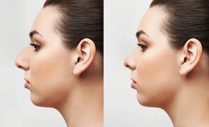 How Long to Recover from Rhinoplasty - Dr Rajat Gupta - Plastic Surgeon in Delhi -01 Rhinoplasty Surgery