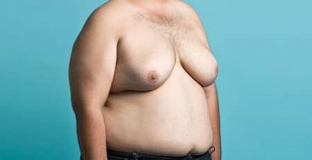 Gynecomastia Surgery