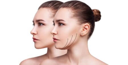mini facelift surgery