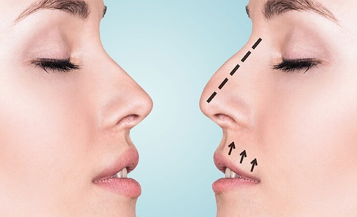 Celebrity Rhinoplasty Surgery in Delhi- Enhancing Beauty in Bollywood - Dr Rajat Gupta - Plastic Surgeon in Delhi -01 Rhinoplasty Surgery