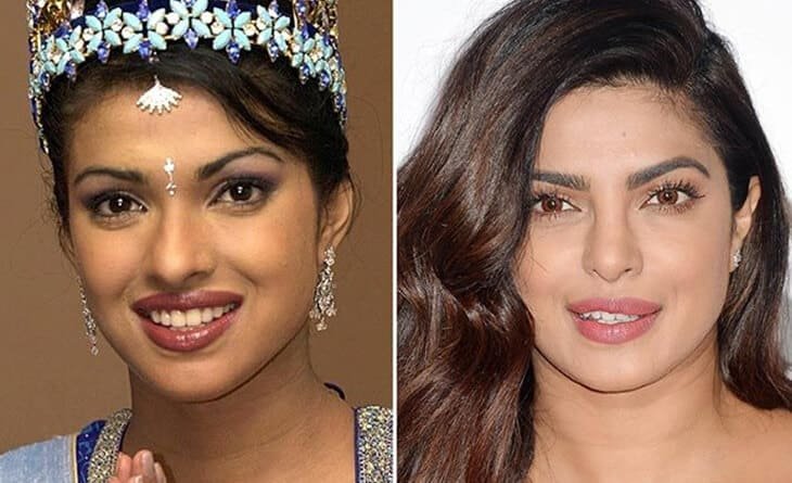 Celebrity Rhinoplasty Surgery in Delhi- Enhancing Beauty in Bollywood - Dr Rajat Gupta - Plastic Surgeon in Delhi -03