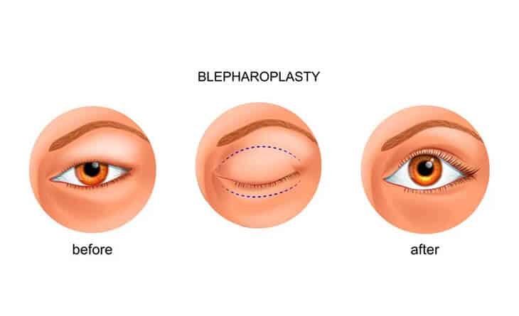 How Much Does Blepharoplasty Cost - Dr Rajat Gupta - Plastic Surgeon in Delhi -01 Blepharoplasty Surgery