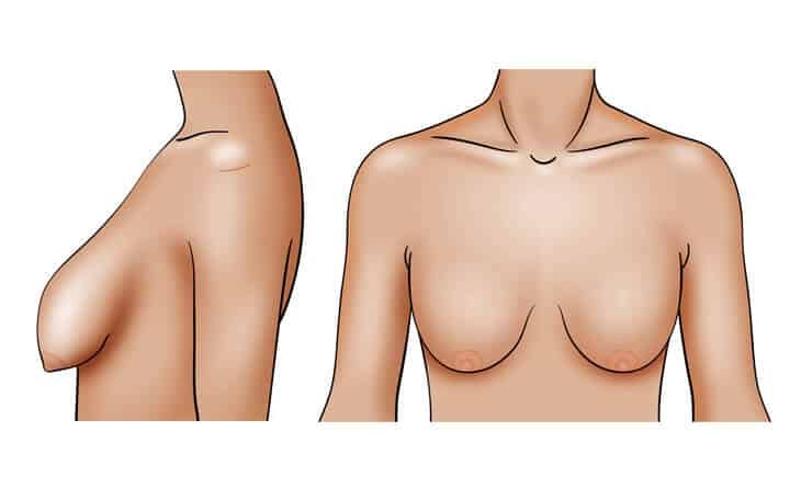 How to Make Your Breasts Perkier - Dr Rajat Gupta - Plastic Surgeon in Delhi -02 Perky Breast