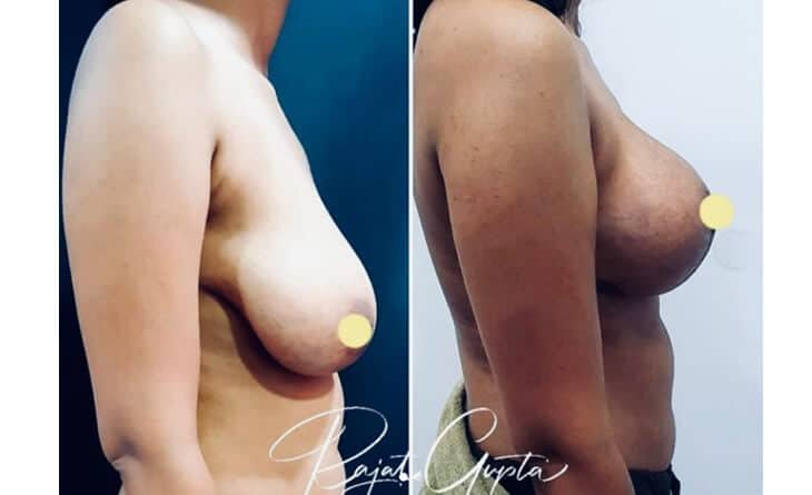 How to Make Your Breasts Perkier - Dr Rajat Gupta - Plastic Surgeon in Delhi -03 Perky Breast