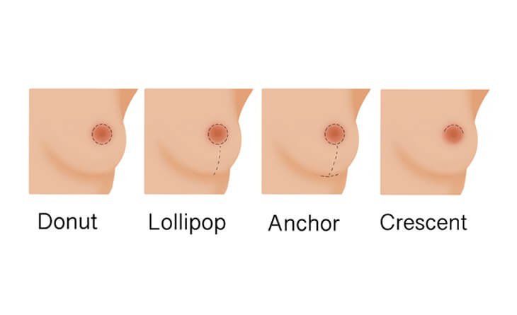 How to Make Your Breasts Perkier - Dr Rajat Gupta - Plastic Surgeon in Delhi -04 Perky Breast
