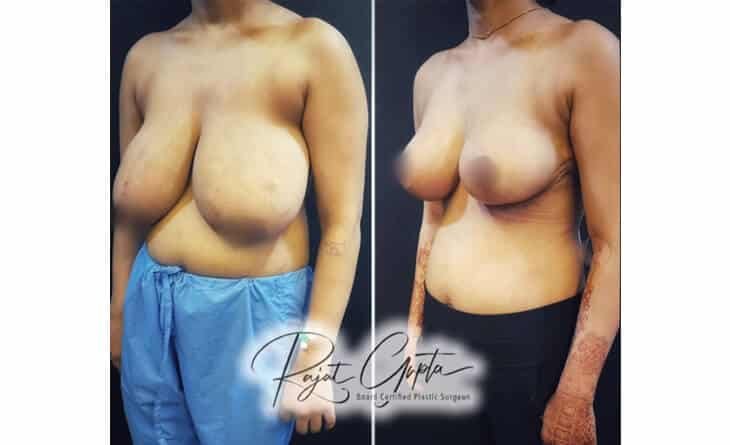 How to Make Your Breasts Perkier - Dr Rajat Gupta - Plastic Surgeon in Delhi -05 Perky Breast