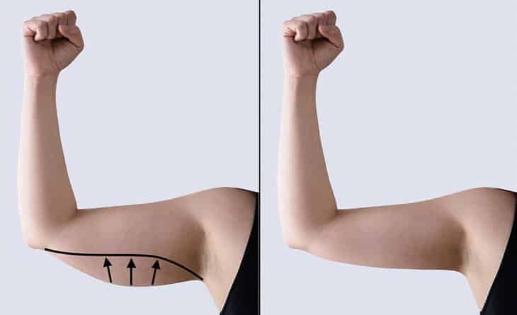 What is the Cost of Arm Liposuction Surgery - Dr Rajat Gupta - Plastic Surgeon in Delhi -01 Arm Liposuction Surgery