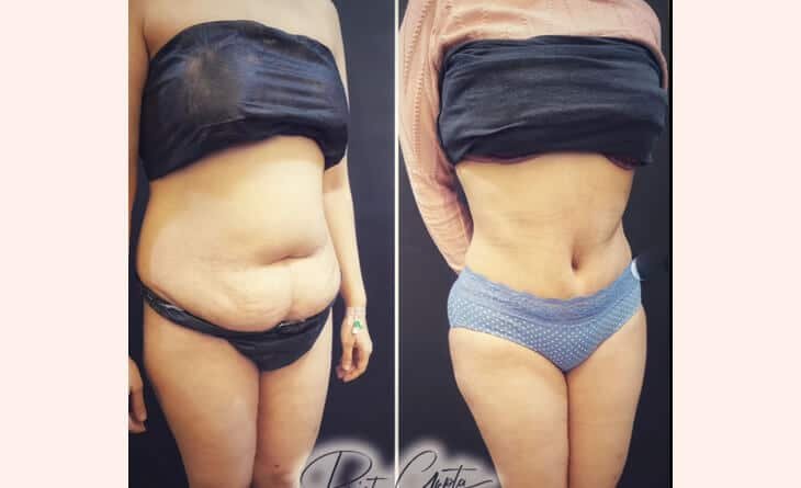 Abdominal Liposuction Surgery - Dr Rajat Gupta - Plastic Surgeon in Delhi -01 abdominoplasty