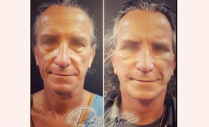 Understanding Neck Lift Surgery - Dr Rajat Gupta - Plastic Surgeon in Delhi -01 Neck Lift Surgery Cost