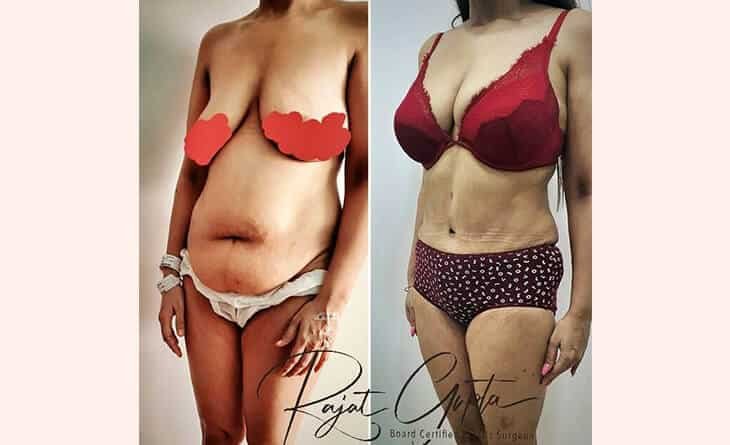 How Much is a Liposuction Surgery - Dr Rajat Gupta - Plastic Surgeon in Delhi - RG Aesthetics -02 liposuction surgery
