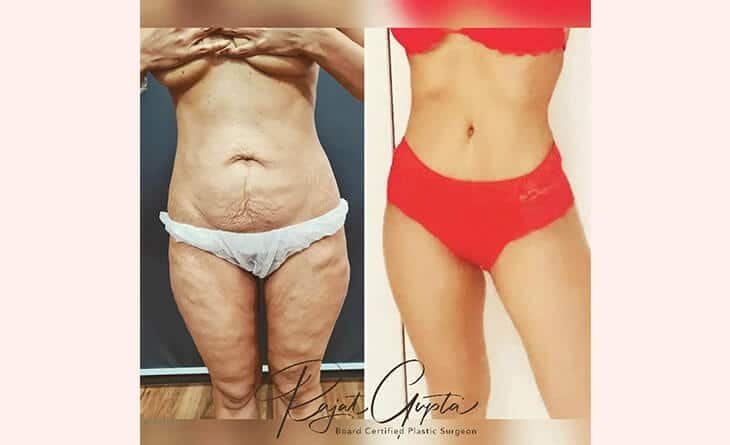 How Painful is a Tummy Tuck Surgery - Dr Rajat Gupta - Plastic Surgeon in Delhi - RG Aesthetics-02 Tummy Tuck Surgery