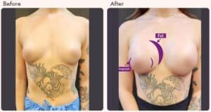 Breast Augmentation