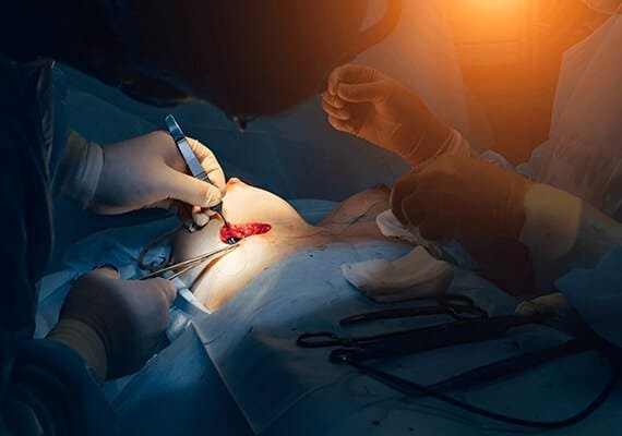 Breast Reconstruction Surgery - Dr Rajat Gupta - RG Aesthetics -04 Breast Reconstruction Surgery