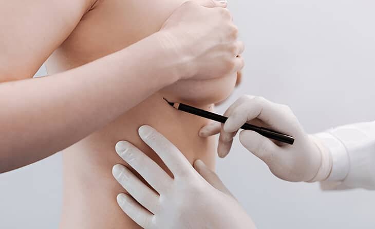 Breast Reconstruction Surgery - Dr Rajat Gupta - RG Aesthetics -05 Breast Reconstruction Surgery
