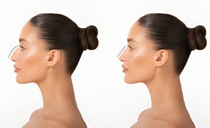 Different Types of Nose Jobs - Dr Rajat Gupta - Plastic Surgeon in Delhi - RG Aesthetics -02 Nose Job Types