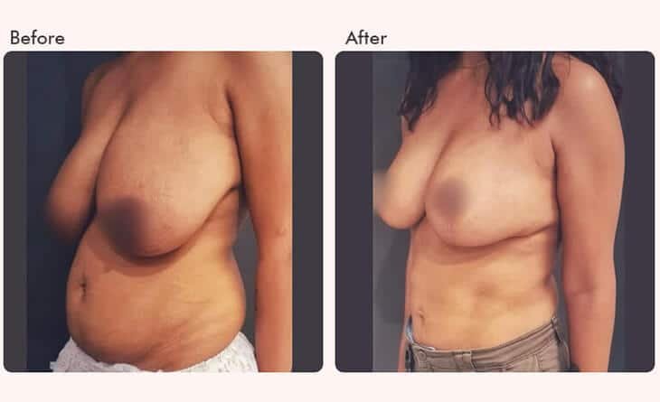 Breast Reduction Before and After Results - Plastic Surgeon in Delhi - Dr Rajat Gupta -02 Breast reduction surgery