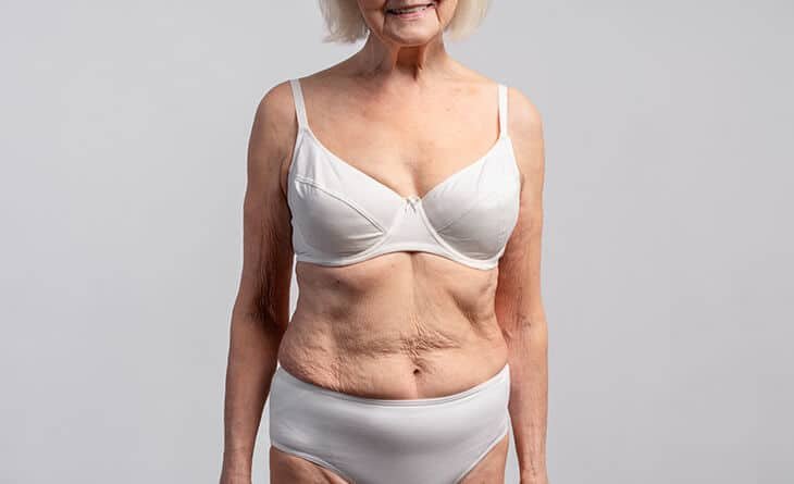 How to Get Rid of Excess Skin After Liposuction Surgery - Dr Rajat Gupta - Plastic Surgeon in Delhi -02 Liposuction Surgery